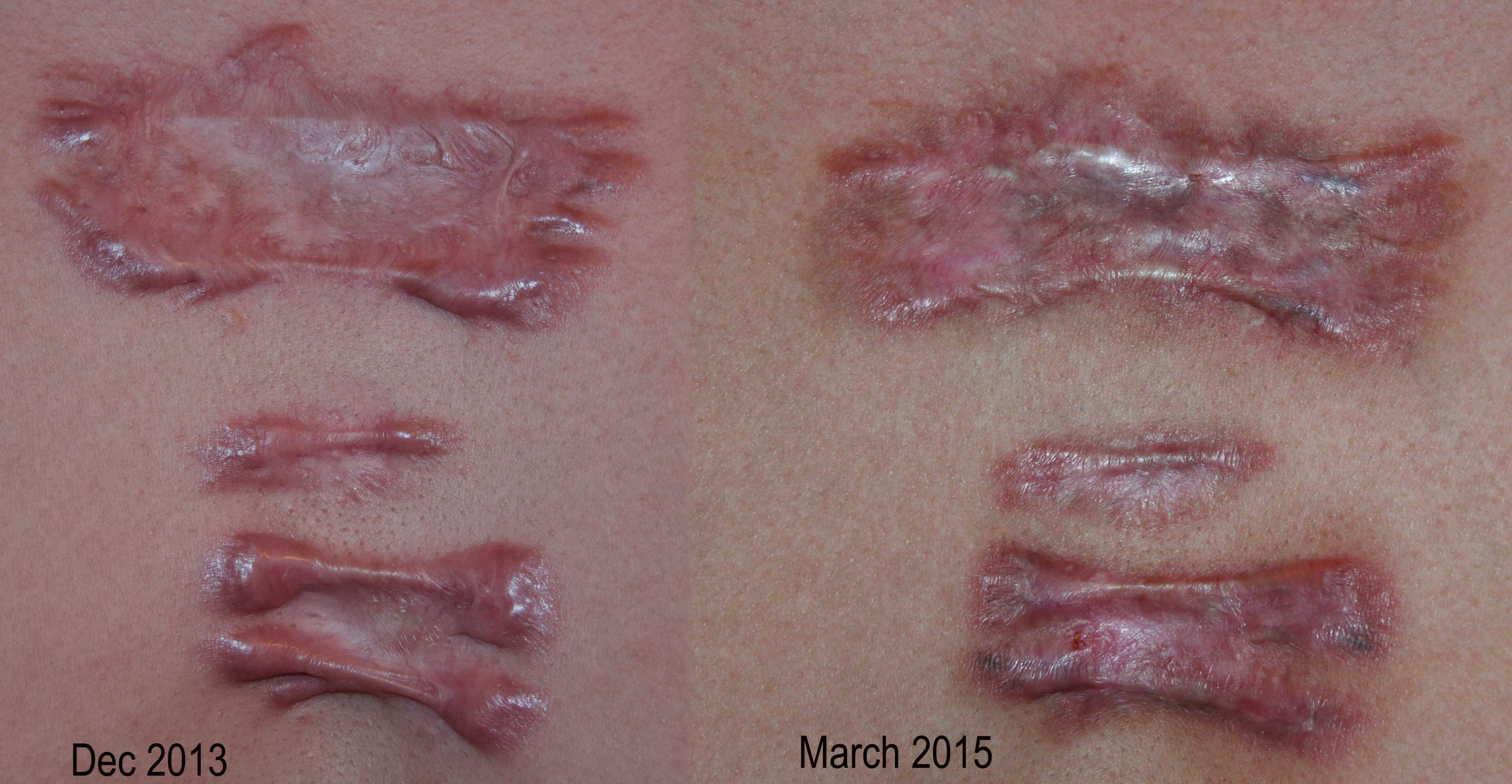 painful keloids and challenging keloid removal expert 226 painful keloids and challenging keloid removal expert 226