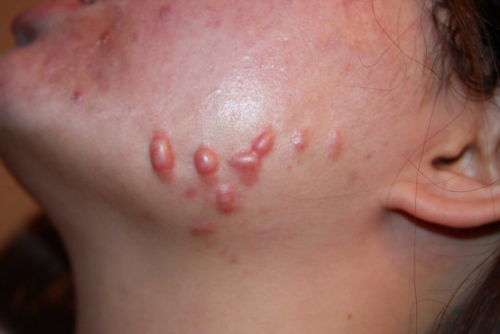 keloids treatment of face keloid keloid keloids treatment of face keloid keloid