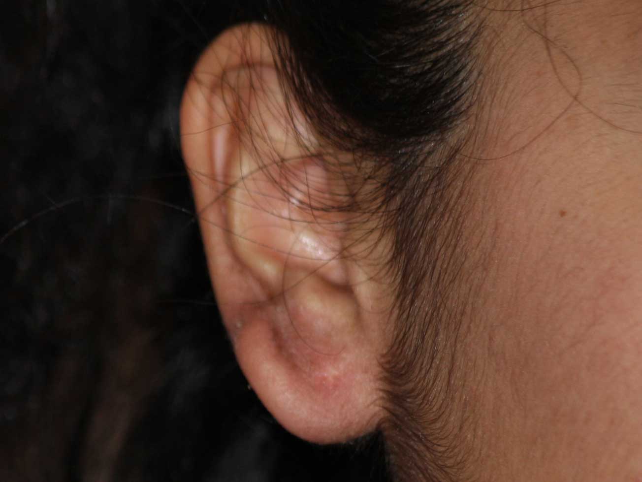 Earlobe Keloids Treated with Cryotherapy Treatment Results