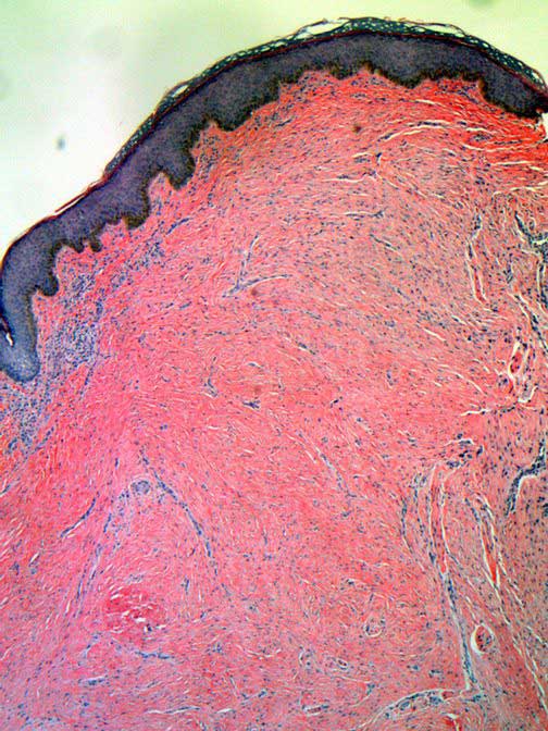 Pathology of Keloid Keloid Removal Expert New York