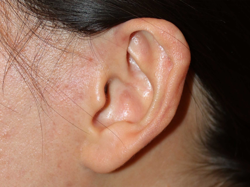 Ear Keloid Cryotherapy Primary Ear Keloid Ear Keloid Removal