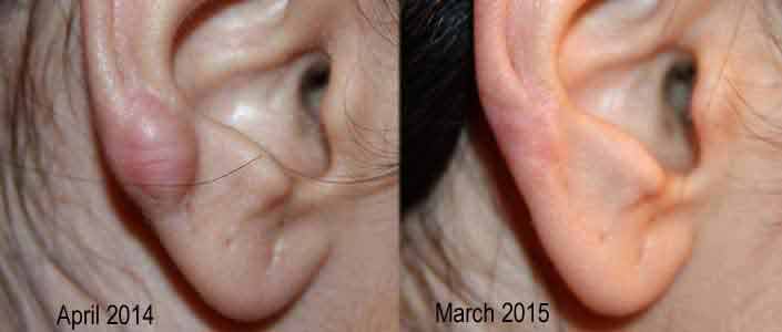 Ear Keloid - Treatment Results with Cryotherapy