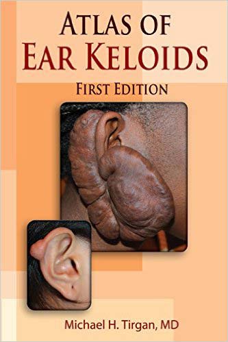 Atlas of Ear Keloids, 1st edition by Dr. Michael Tirgan