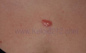 Early Stage Chest Keloid