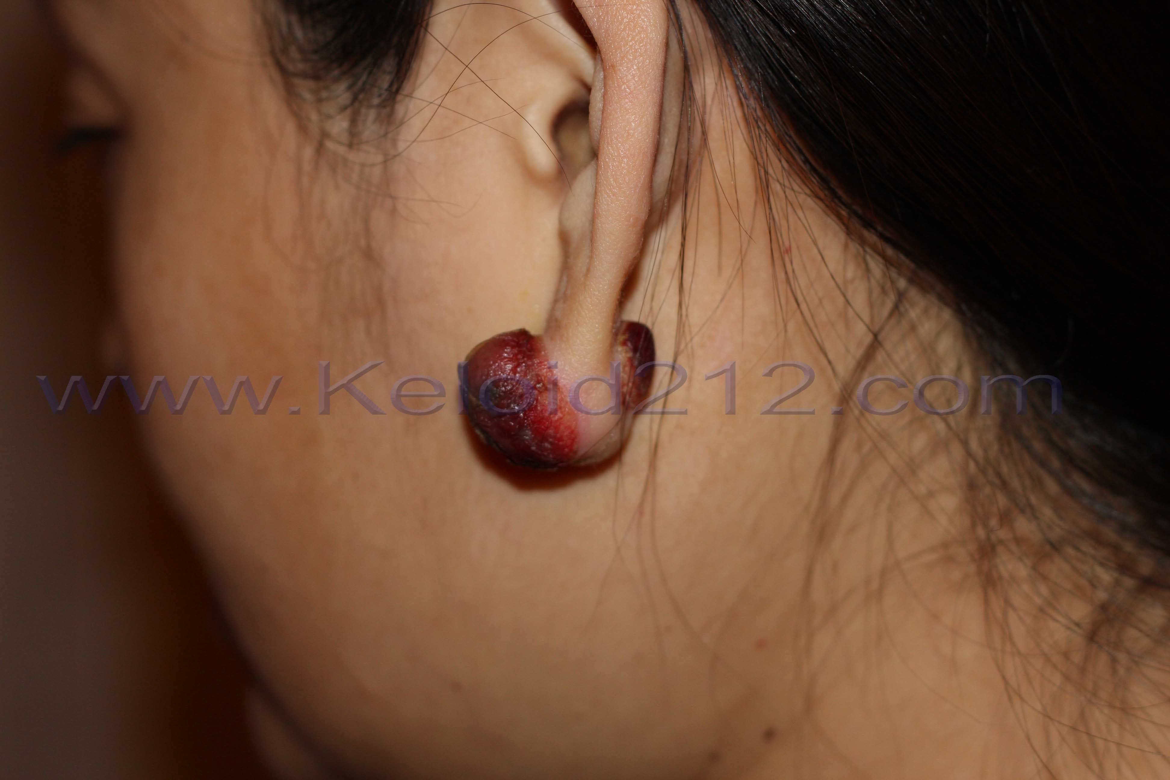 Earlobe Keloid Treatment