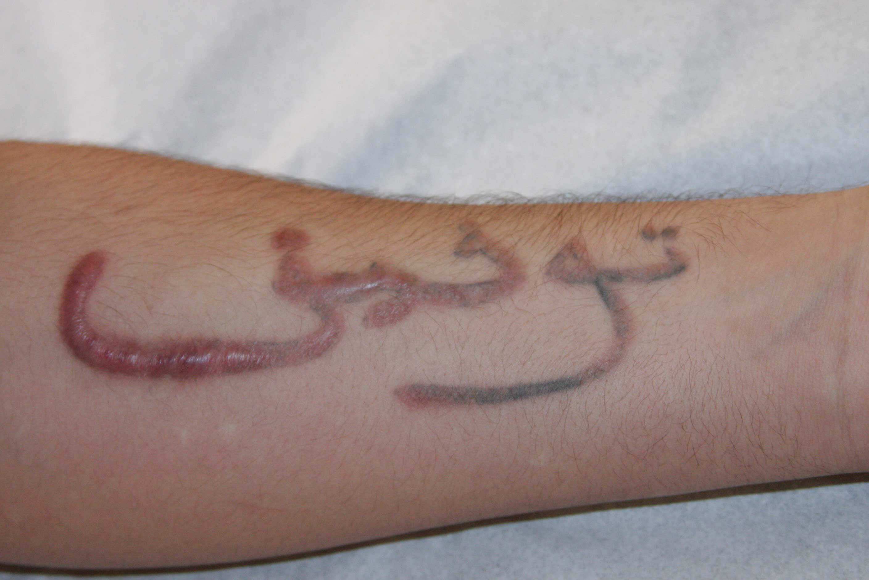 The Scar Management Side of Tattoo Removal  Biodermiscom  Biodermis