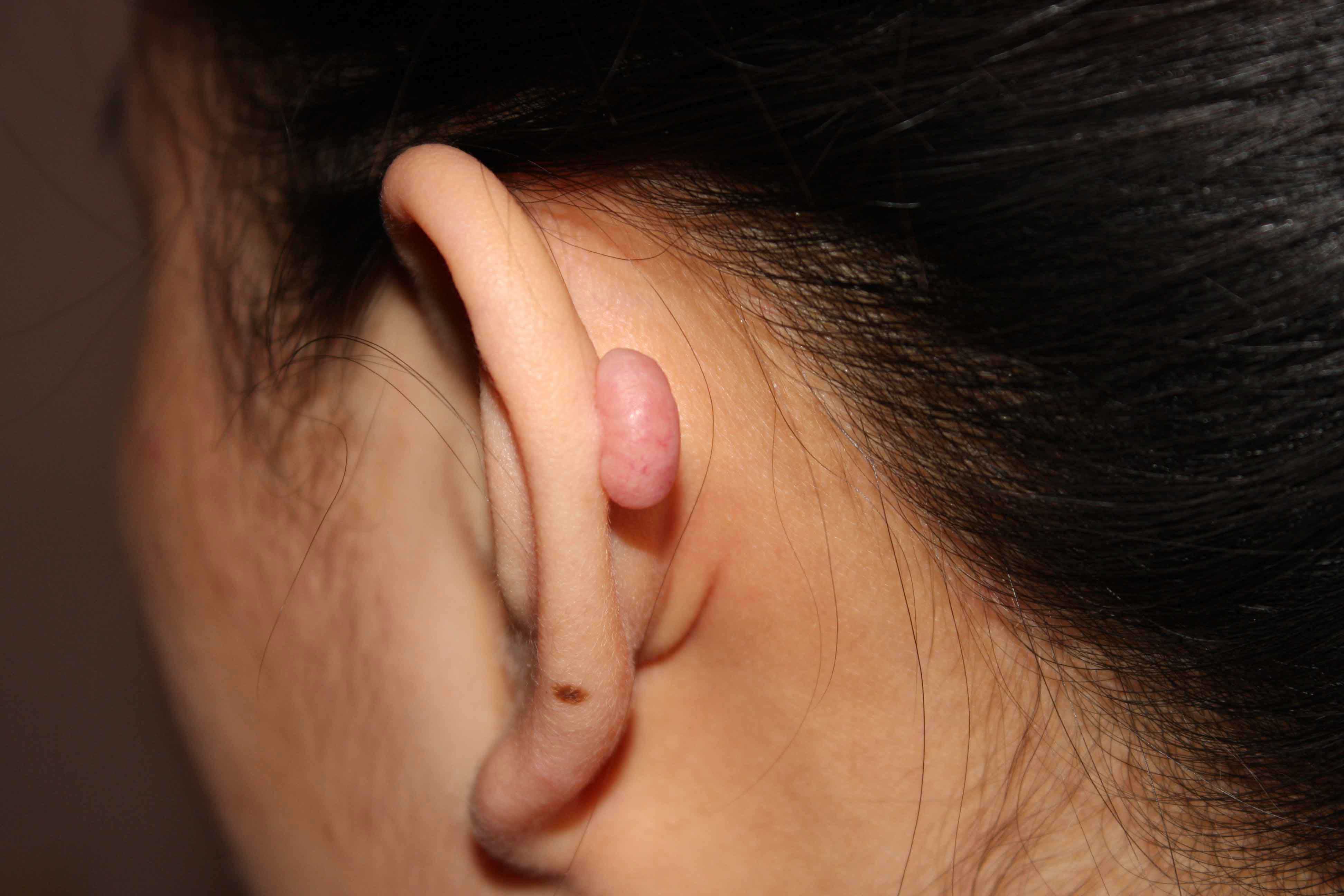 Ear Helix Keloid