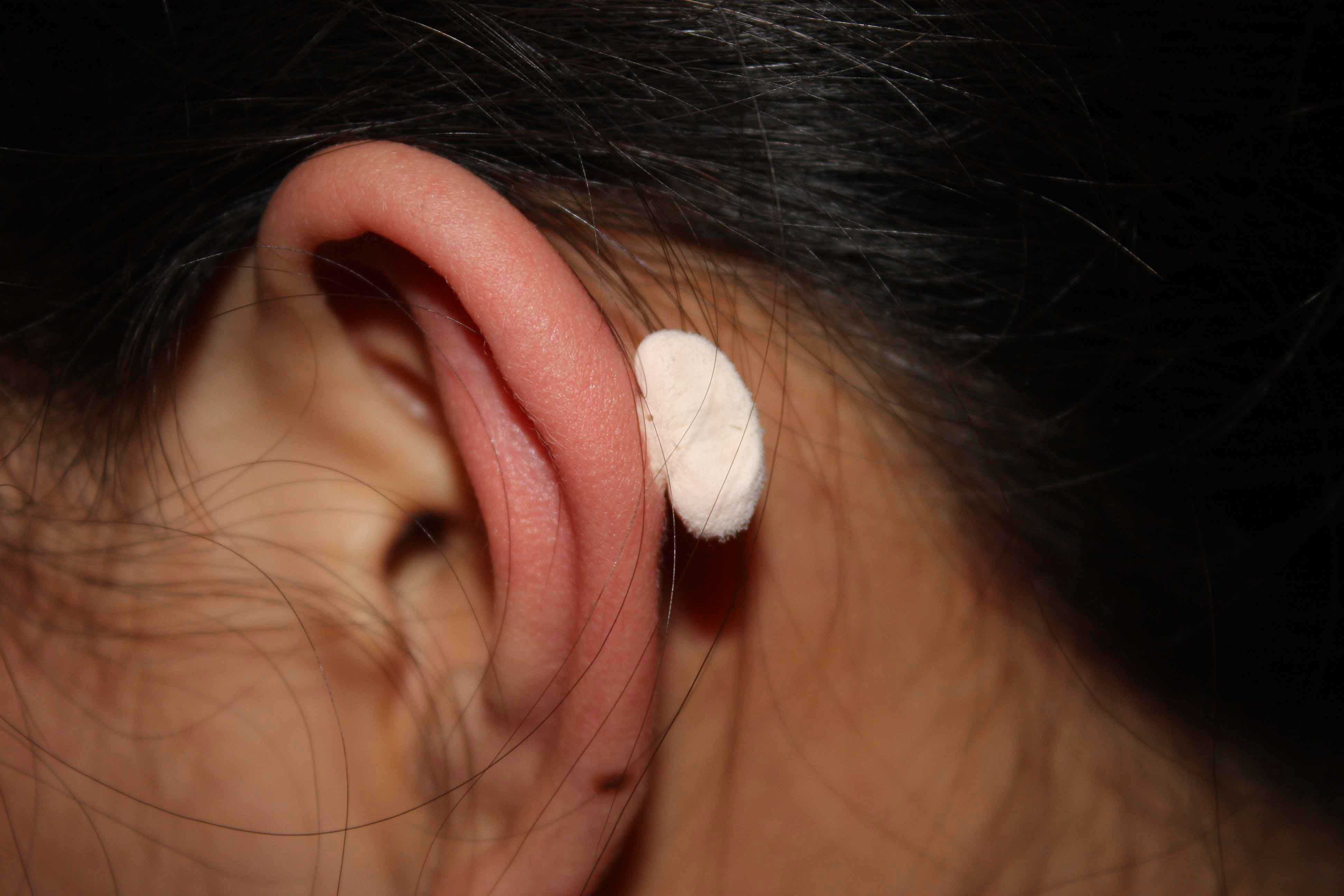 Ear Helix Keloid