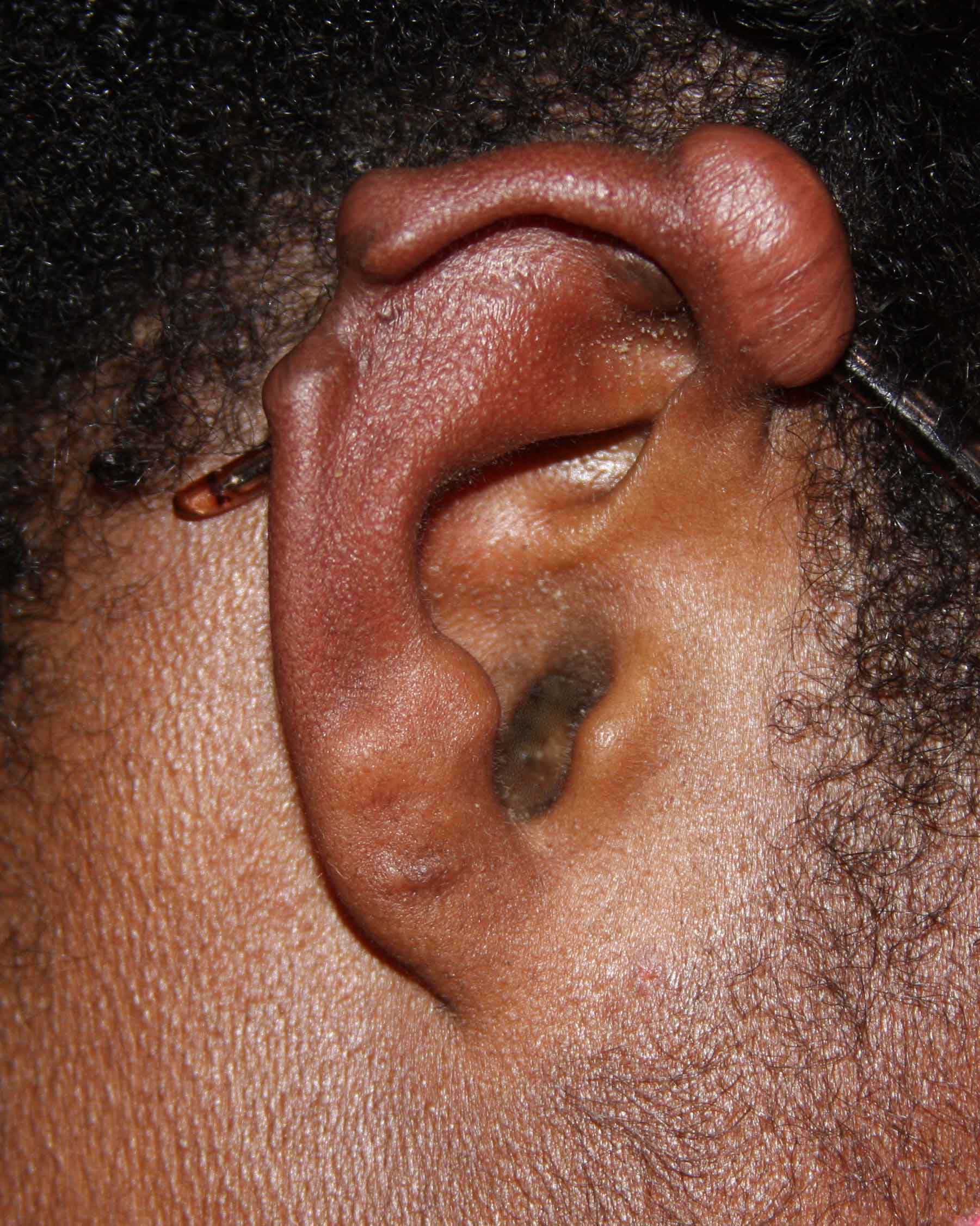Rubber Band Causing Loss of Ear Tissue Rubber Band Causing Loss of Ear Tissue