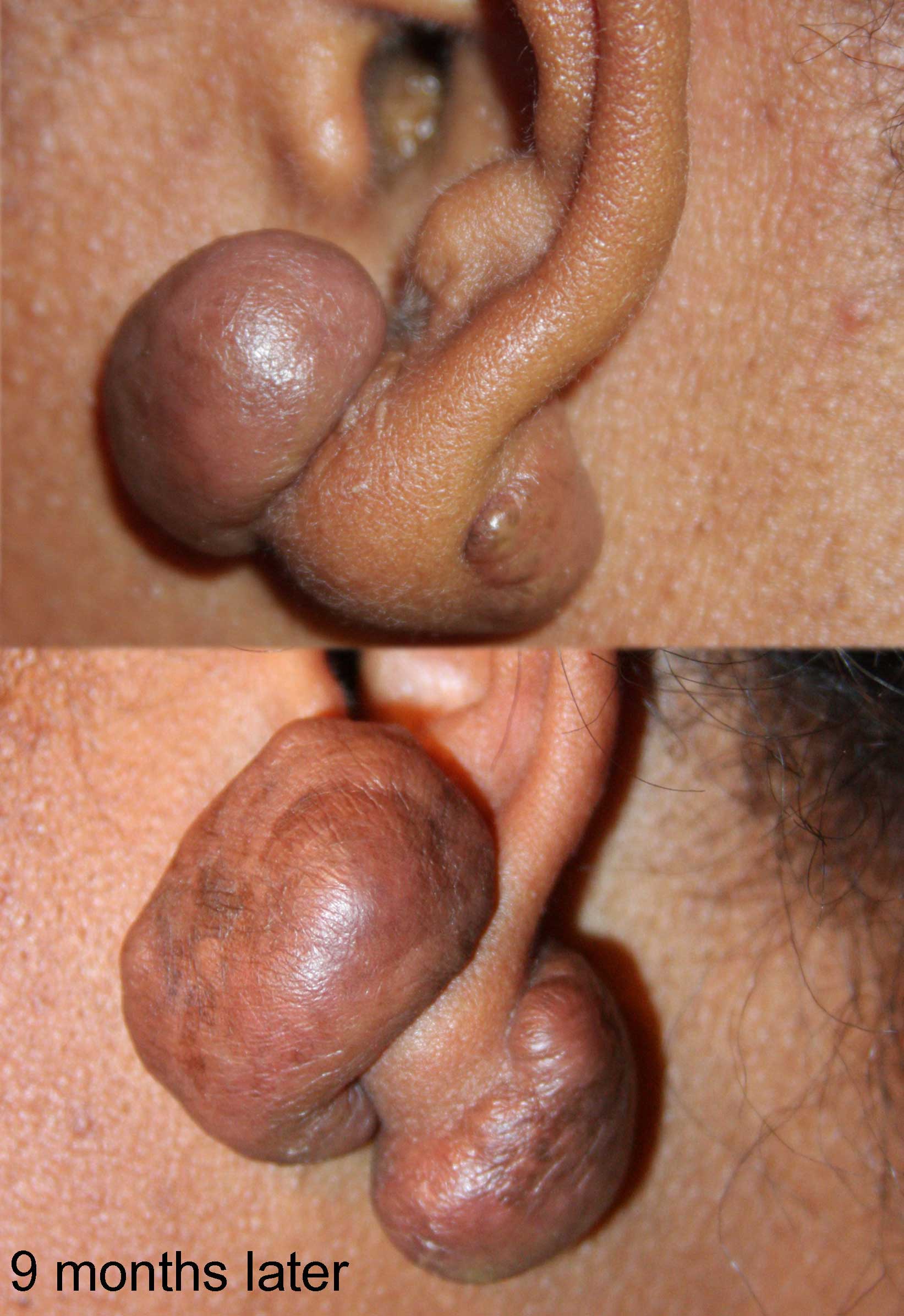 KRF Clinical Practice Guidelines in Keloid Disorder