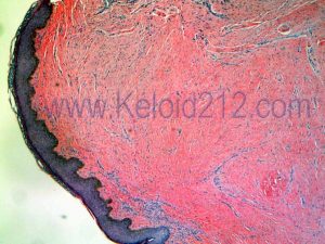 keloid pathology