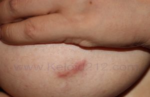 Linear Breast Keloid