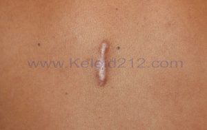 Linear Vertical Chest Keloid