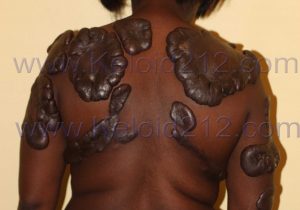 Extensive Stage Keloids