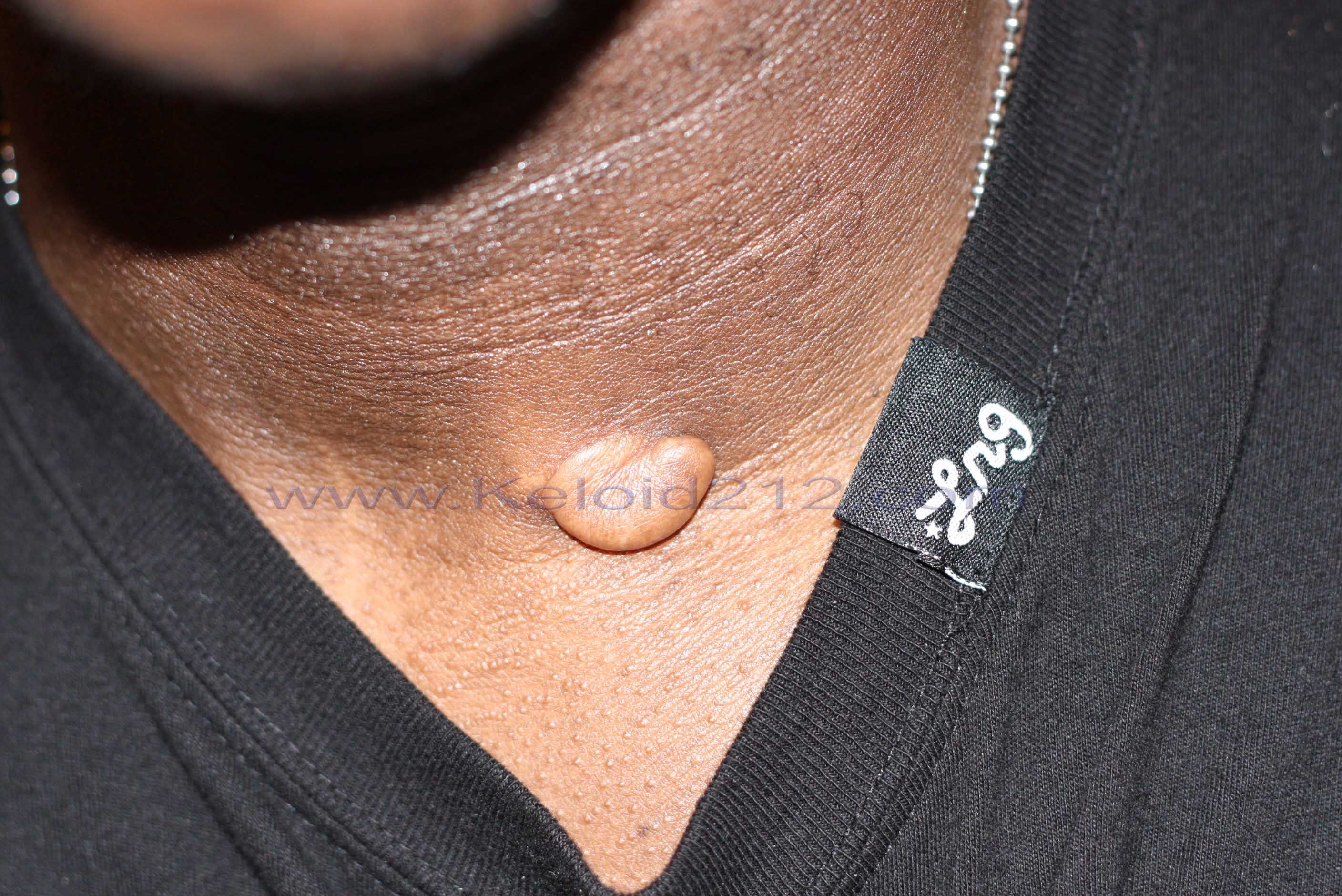 Neck Keloid - Tumoral Tumoral Neck Keloid