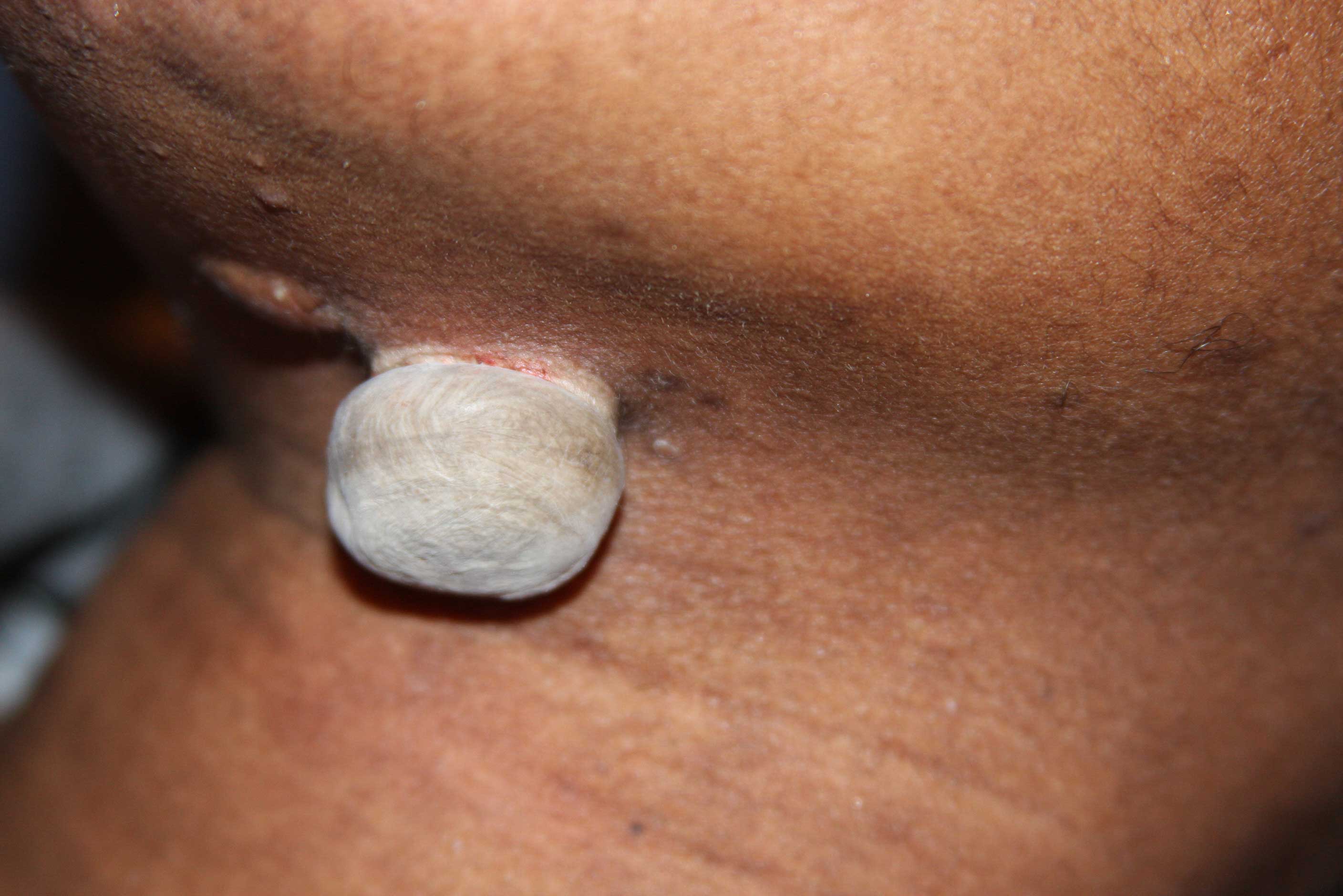 Tumoral Neck Keloid immediately after the application of cryotherapy