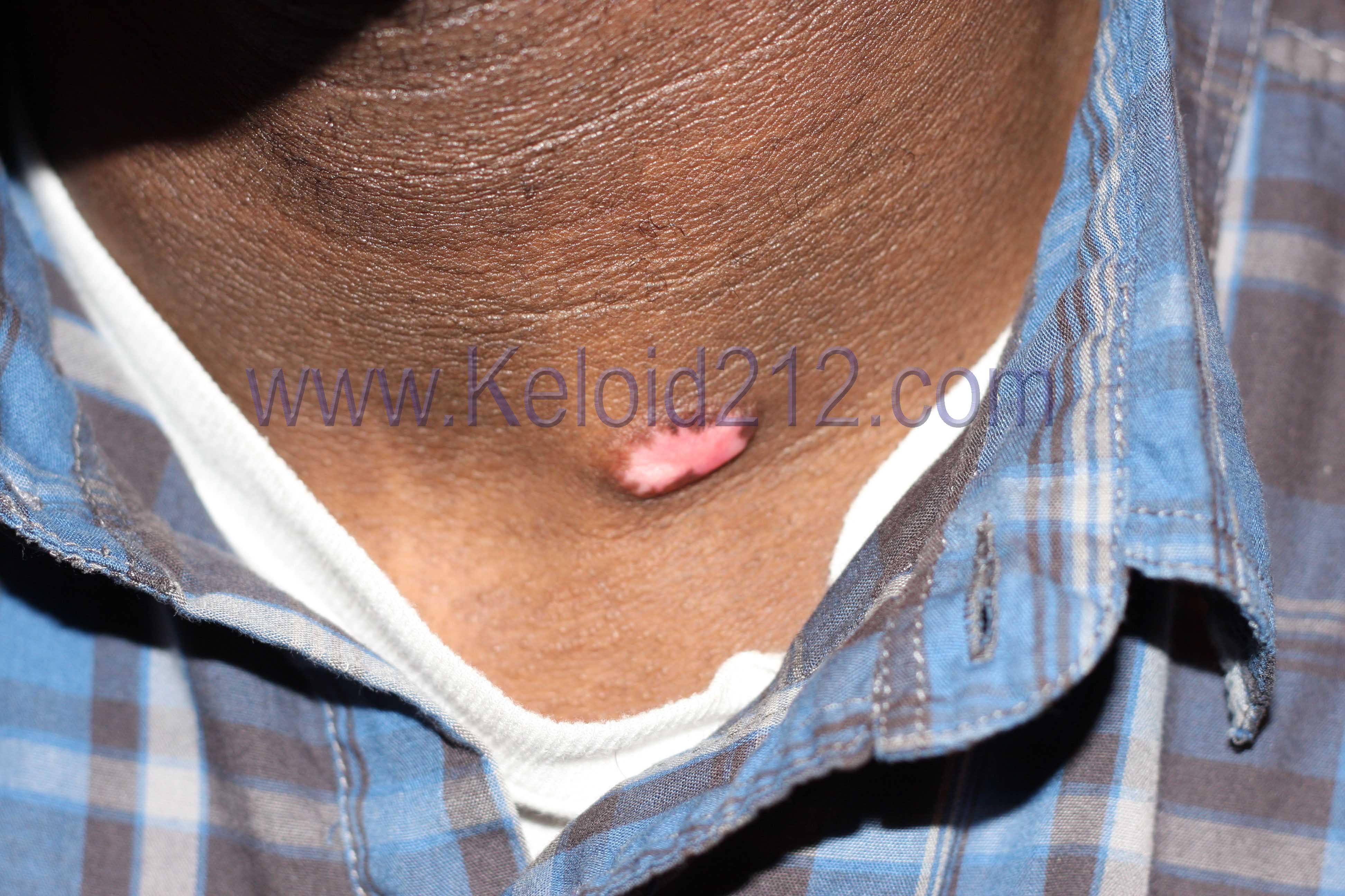 Neck Keloid - After two cycles of cryotherapy