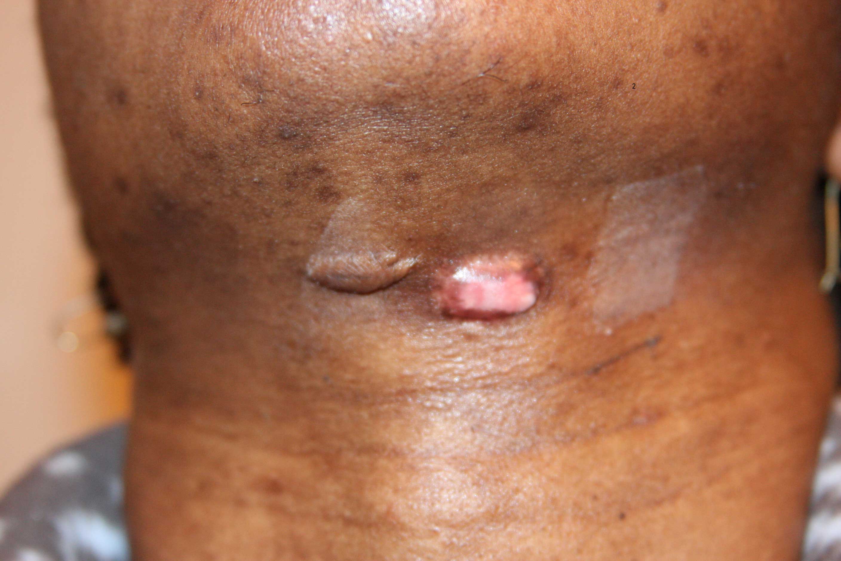 Tumoral Neck Keloid treated with cryotherapy