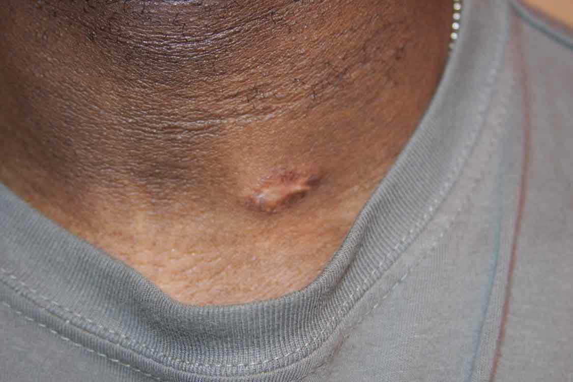 Neck Keloid - Treated with cryotherapy