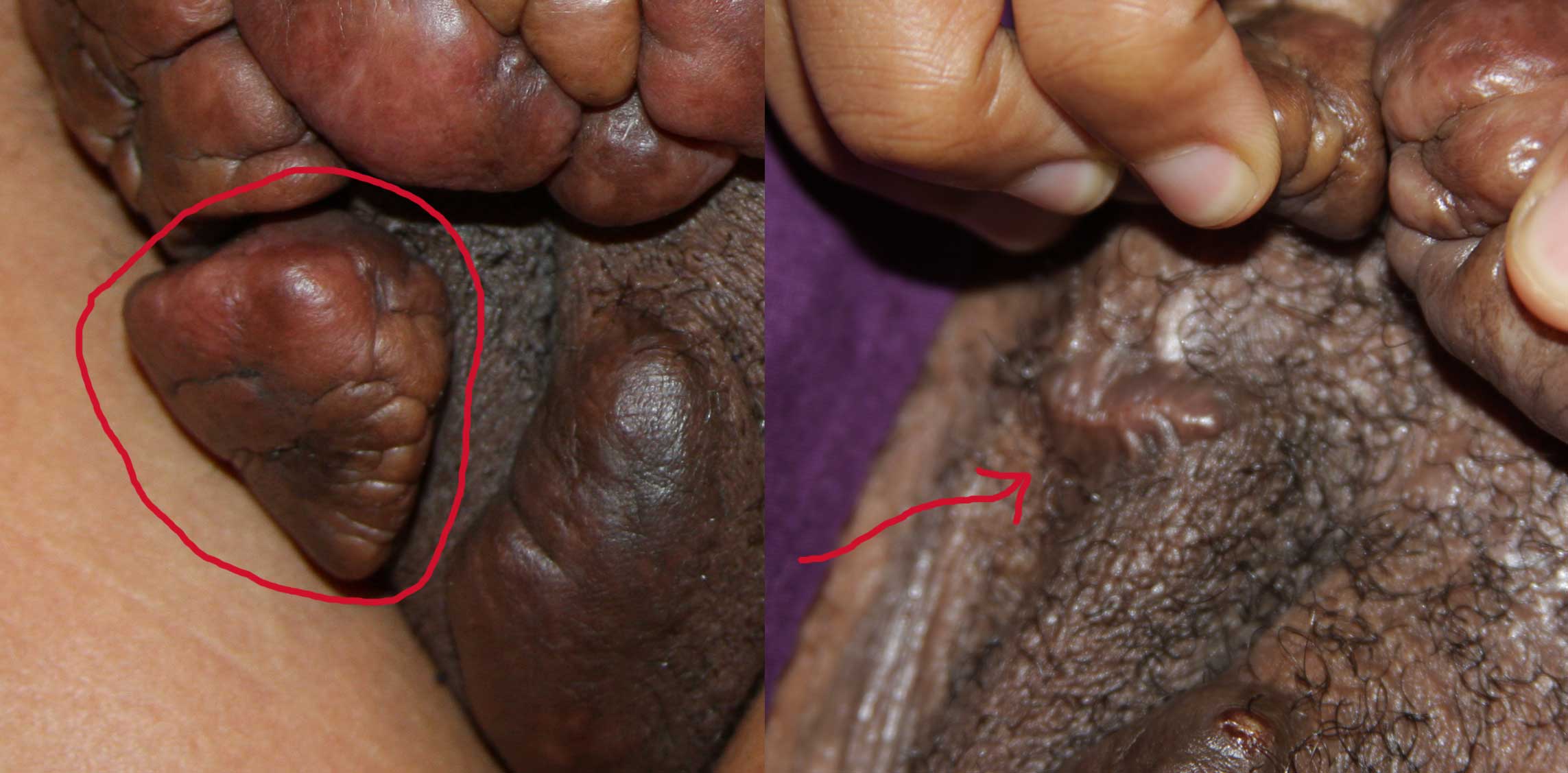 Massive Pubic Keloid treated with Cryotherapy