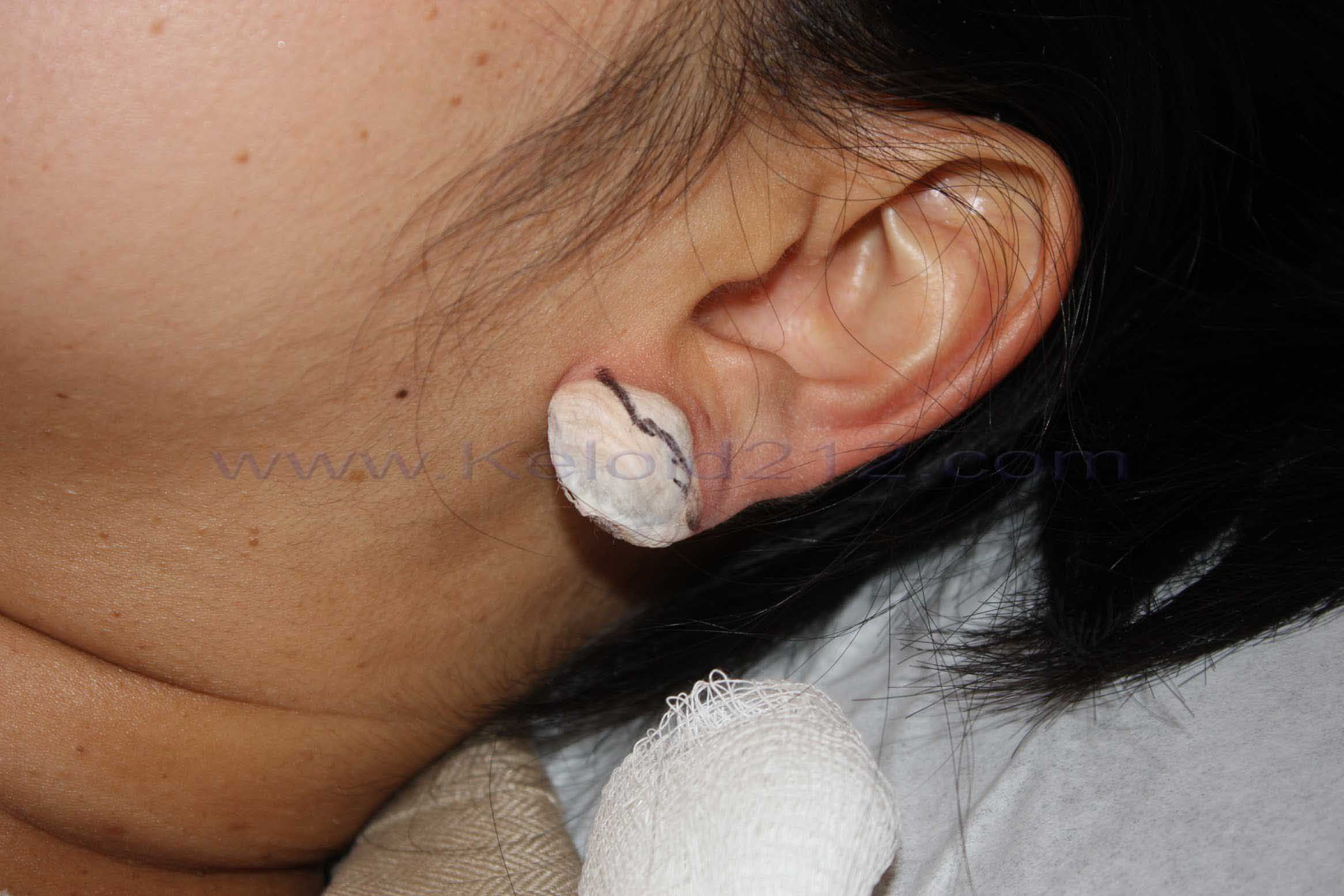 Reshaping earlobe with cryotherapy