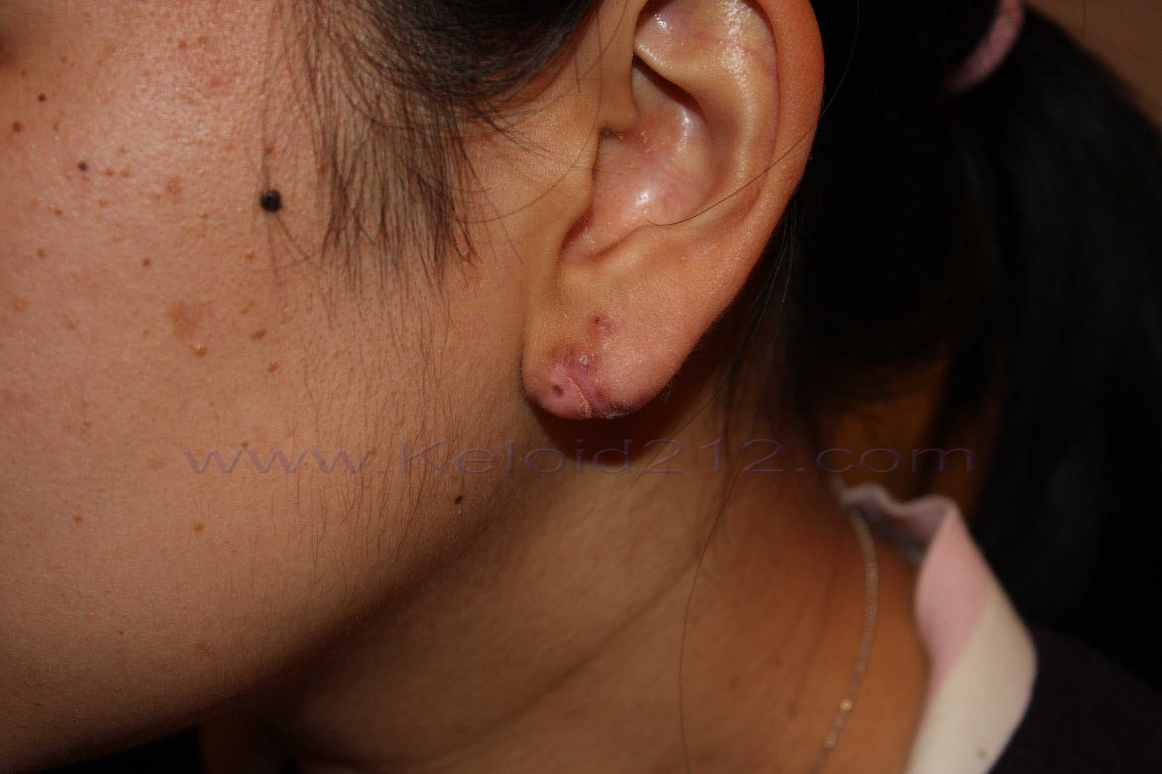 Reshaping Earlobe Keloid with Cryotherapy Reshaping Earlobe Keloid with Cryotherapy: