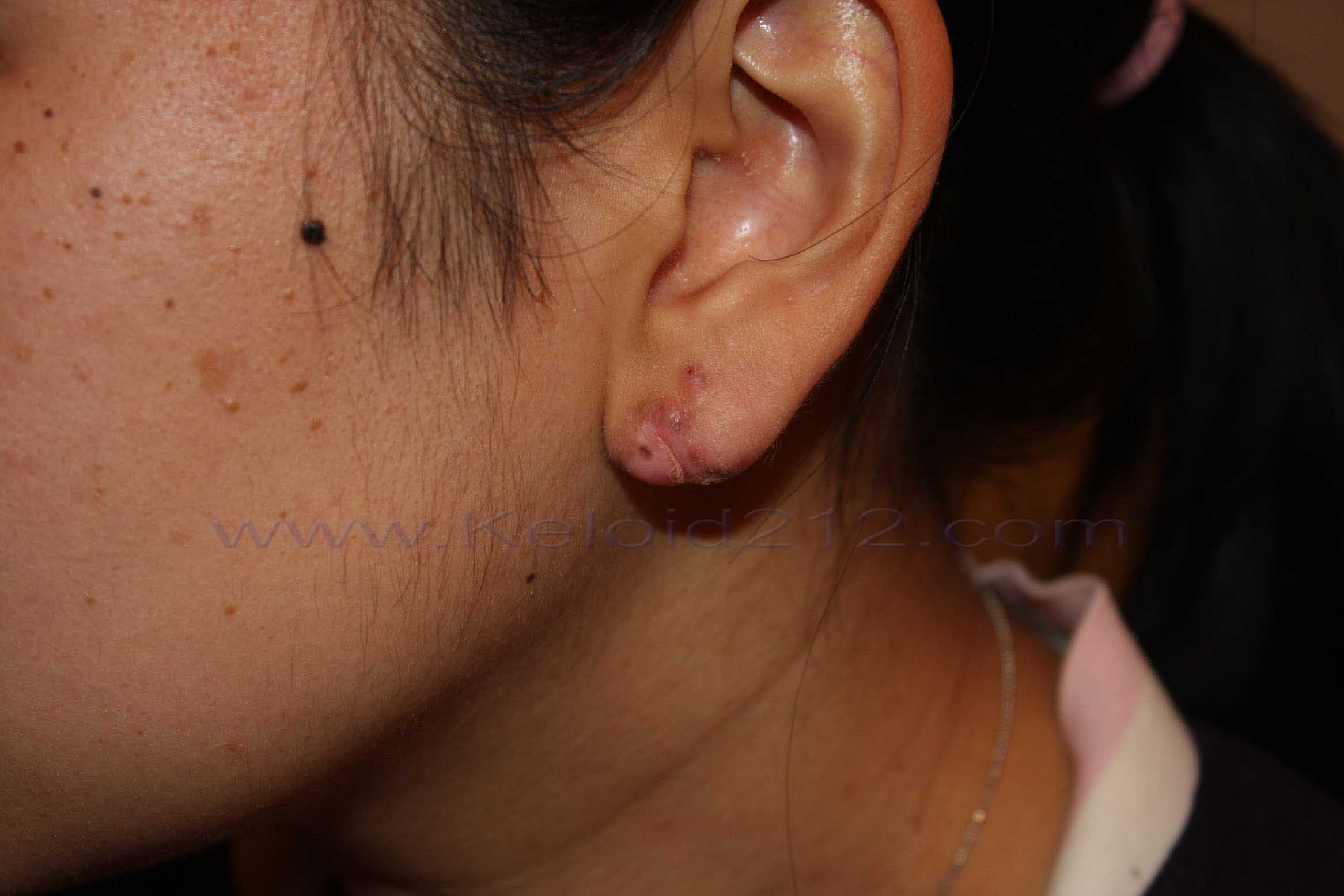 Reshaping Earlobe Keloid with Cryotherapy: 