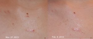 Chest Keloid