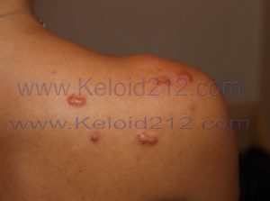 multifocal shoulder keloids
