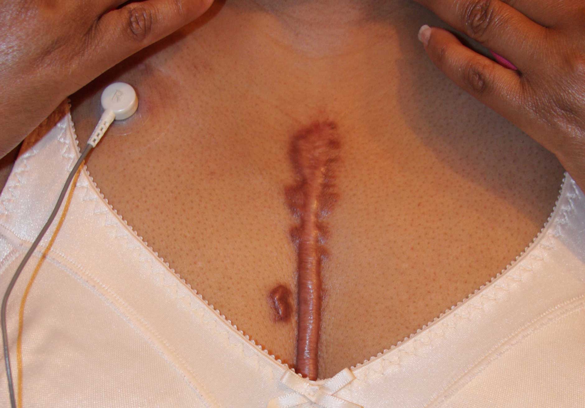 POST STERNOTOMY PAINFUL CHEST KELOID