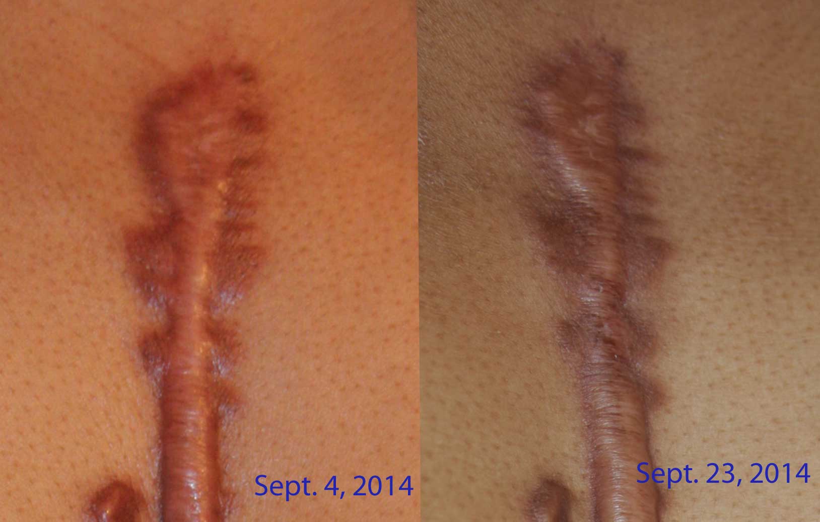 Chest Keloid Treated with Chemotherapy