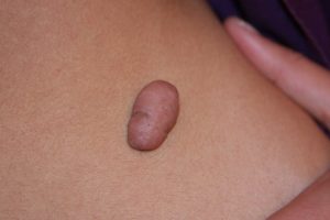 Abdominal Keloid