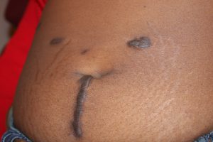 Abdominal Keloids