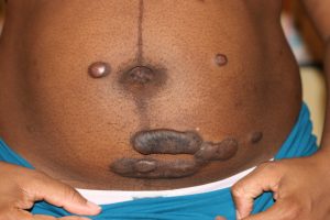 Abdominal Keloids