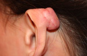 Ear Helix Keloid
