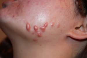 Nodular keloids, left side of the face