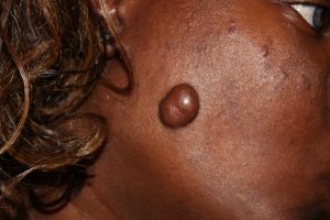 Facial keloid tumor in a young African American Female