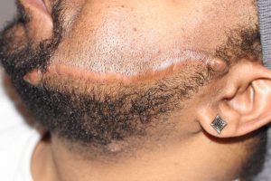 Facial Keloid