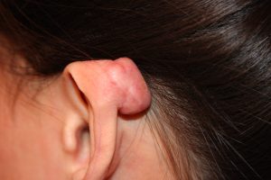 Ear Keloid Treatment