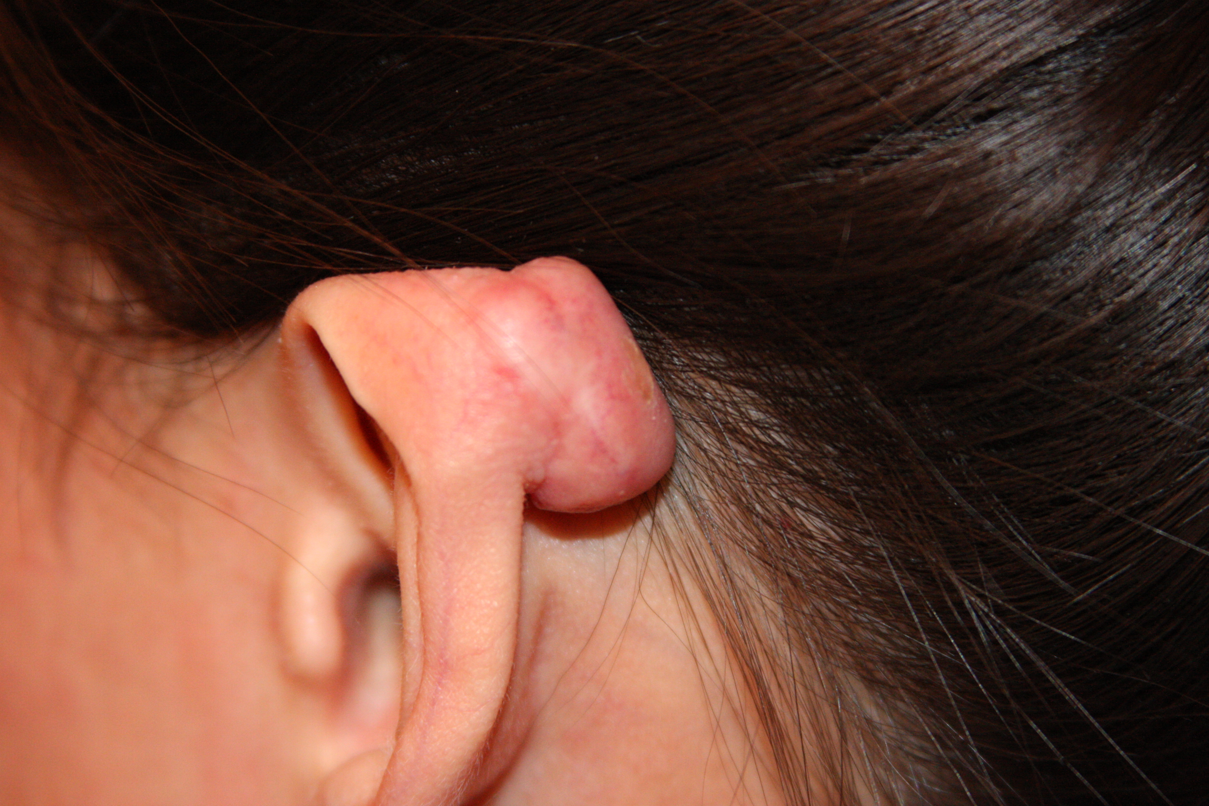 Tumoral Ear Keloid 