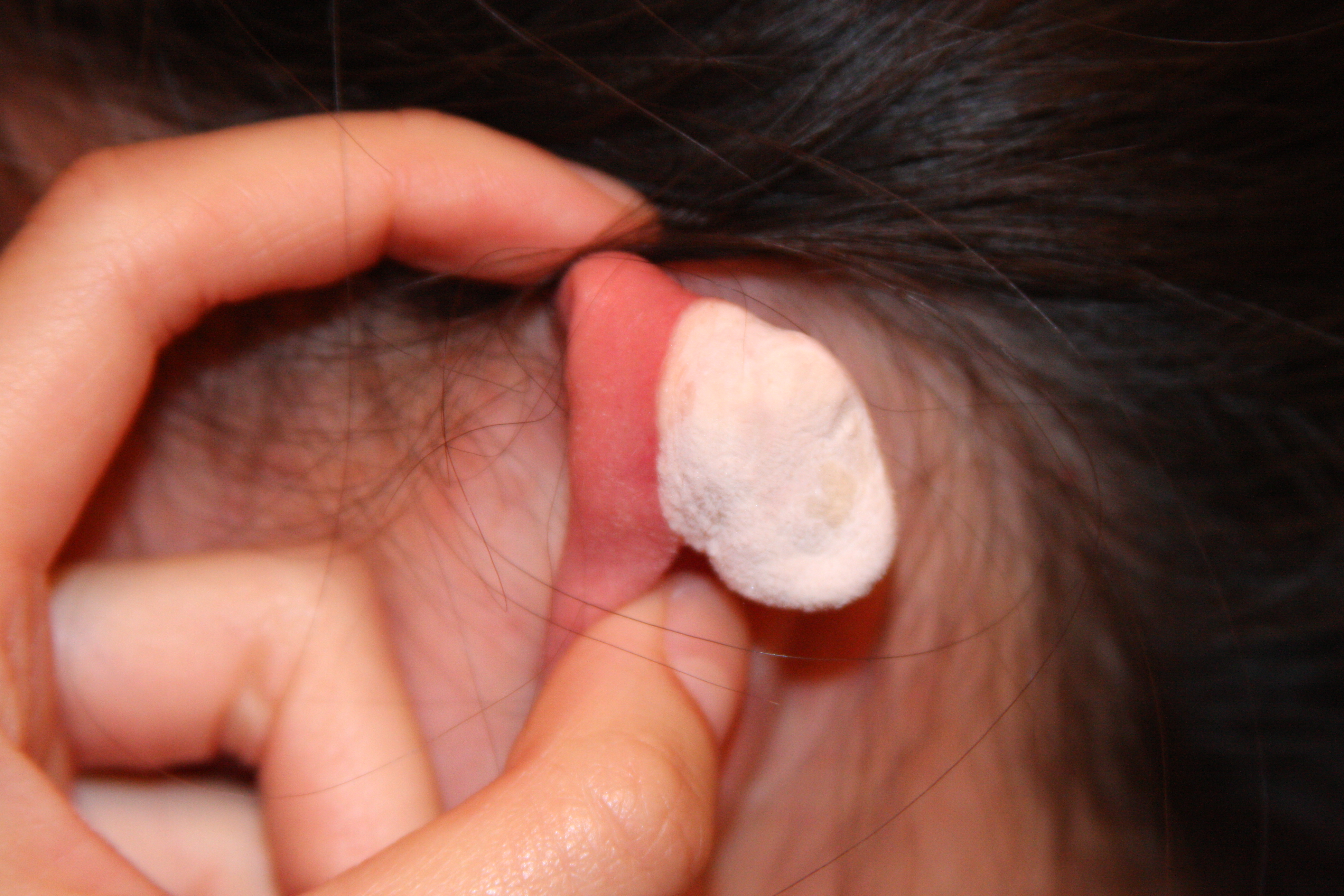 Cryotherapy for ear keloids