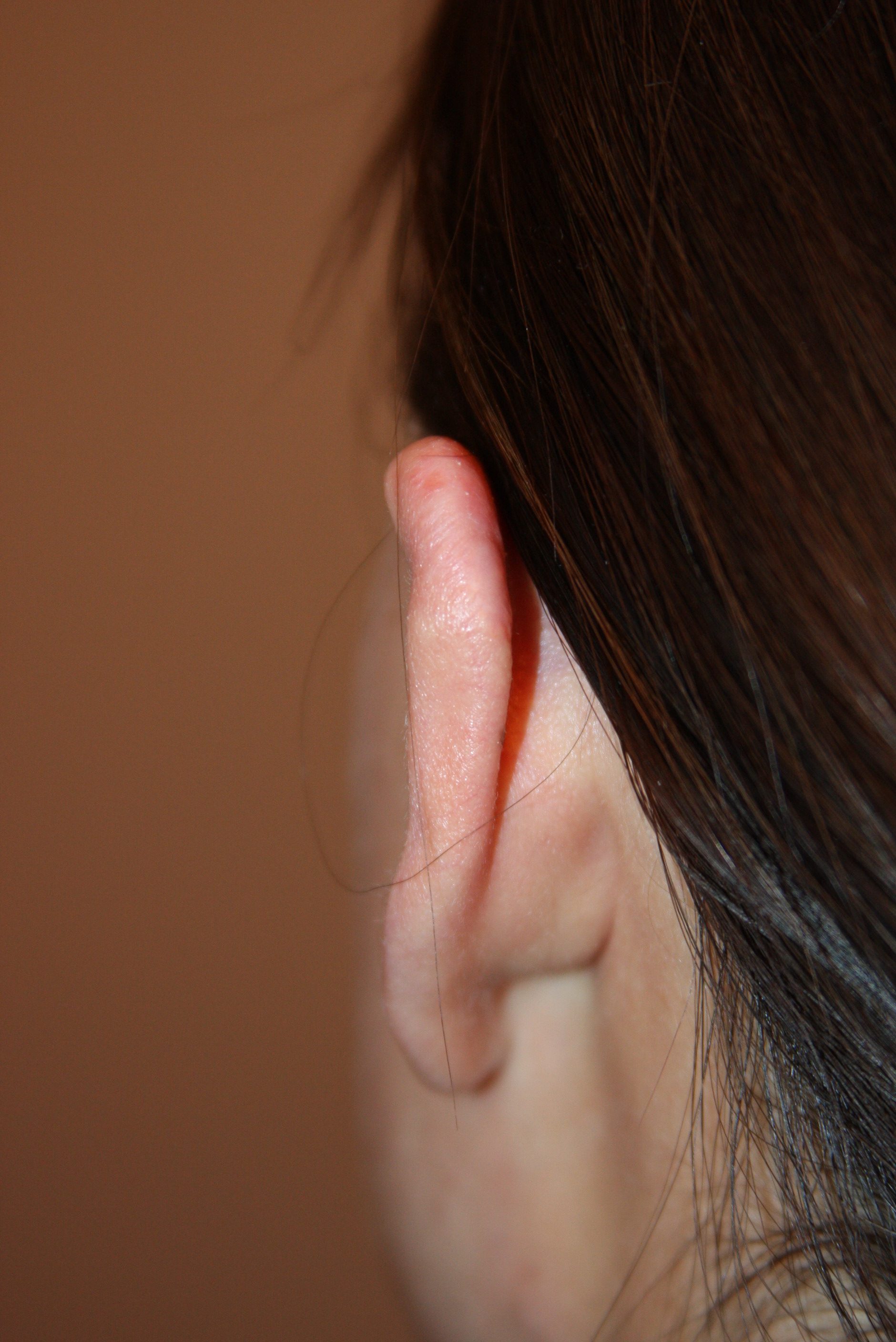 Ear Keloid final and durable results, follow up visit - 5 years later. Final results, follow up visit - 5 years later.