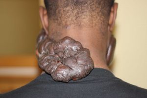 Massive Neck Keloid Caused by Prior Keloid Removal Surgeries