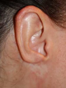 Loss of Ear Tissue to Keloid Removal Surgery