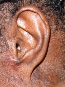 Loss of Ear Tissue to Keloid Removal Surgery