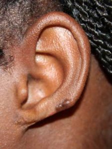 Loss of Ear Tissue to Keloid Removal Surgery