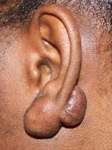 Keloid Recurrence after surgery.