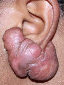 Keloid Recurrence after surgery.