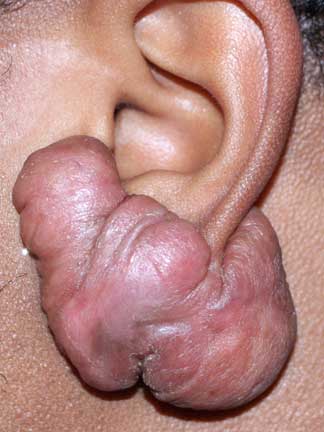 Semi-Massive Ear Keloid