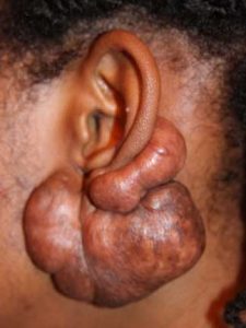 Keloid Recurrence after surgery.